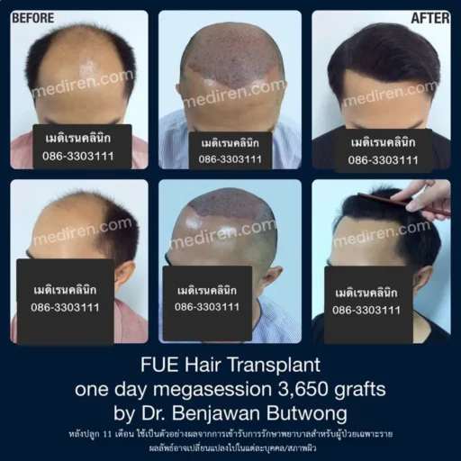 หมอเบญ หรือหมอเบน ตัวจริงเรื่องการปลูกผม FUE แพทย์อเมริกันบอร์ดปลูกผม กรรมการเทรนนิ่งแพทย์ปลูกผม ISHRS แพทย์ชำนาญการด้านการปลูกผมกว่า 15 ปี ปลูกผมที่เมดิเรน คลินิก หมอเบนดูแลเองทุกเคส